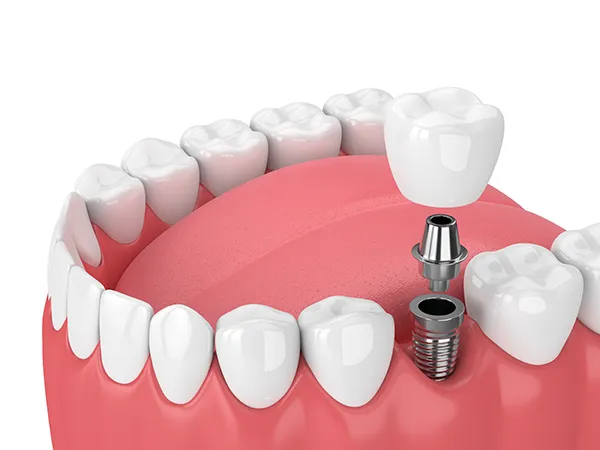 3D rendering of a dental implant and its components (screw, abutment, and crown) being placed into the jaw 3D rendering of a dental implant and its components (screw, abutment, and crown) being placed into the jaw